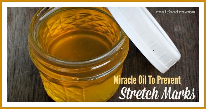 Miracle Oil To Prevent Stretch Marks | Real Food RN